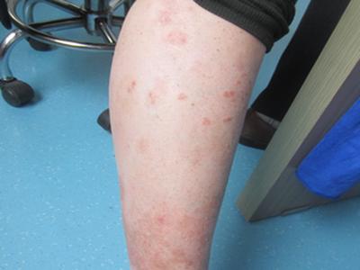 儿童牛皮癣应该如何治疗呢